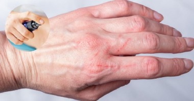 acido hialuronico heridas interior v2